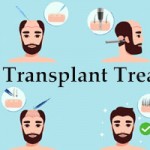 Hair Transplant in Rajkot – Best Hair Transplant Centre in Rajkot